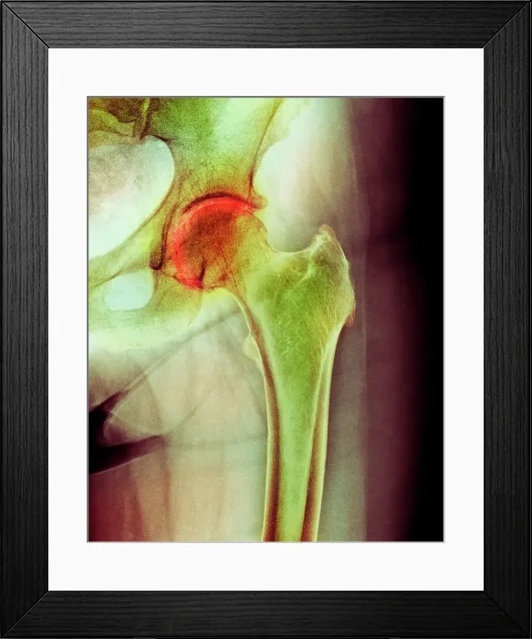 Framed Print : Arthritis of the hip, X-ray Framed Print : Arthritis of the hip, X-ray