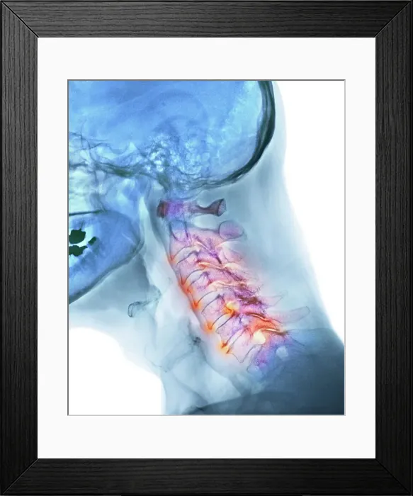 Framed Print : Arthritis of the neck, X-ray Framed Print : Arthritis of the neck, X-ray
