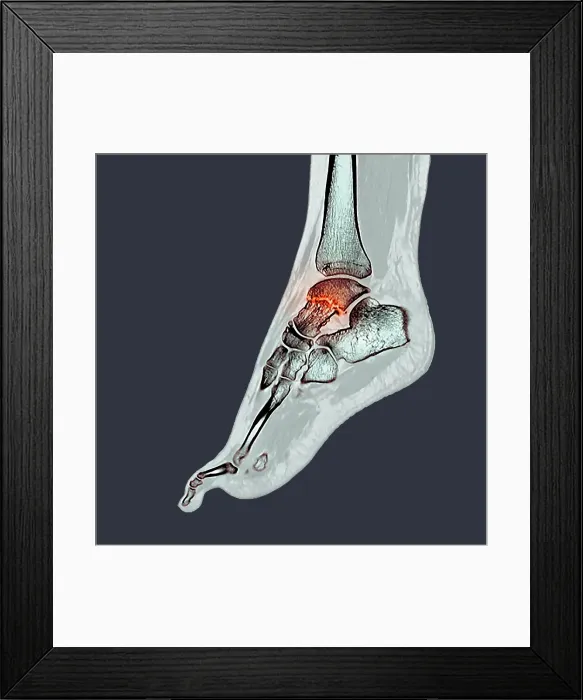 Framed Print : Fractured ankle bone, CT scan Framed Print : Fractured ankle bone, CT scan