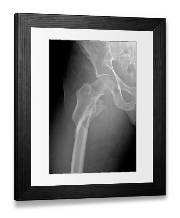 Framed Print : Hip fracture, X-ray Framed Print : Hip fracture, X-ray