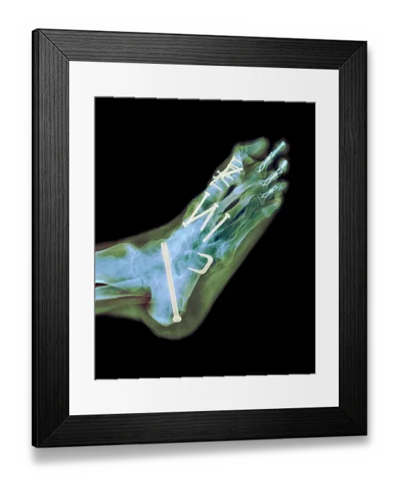 Framed Print : Surgical fixation for rheumatoid arthritis of feet, X-ray Framed Print : Surgical fixation for rheumatoid arthritis of feet, X-ray