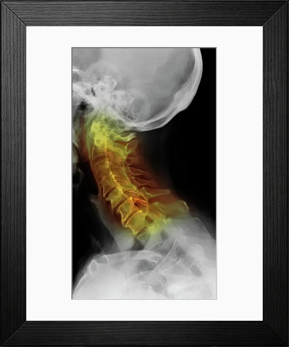 Framed Print : Osteoarthritis of the cervical spine, X-ray Framed Print : Osteoarthritis of the cervical spine, X-ray