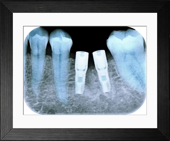 Framed Print : Dental implants following tooth extraction, X-ray Framed Print : Dental implants following tooth extraction, X-ray