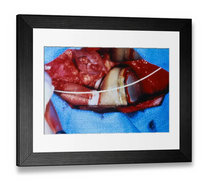 Framed Print : Surgeons Replacing a Heart Framed Print : Surgeons Replacing a Heart