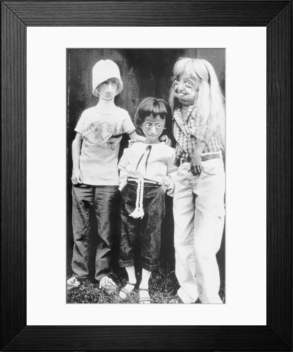Framed Print : Girls with Progeria Framed Print : Girls with Progeria