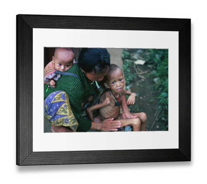 Framed Print : Emaciated Child with Relief Services Aide Framed Print : Emaciated Child with Relief Services Aide