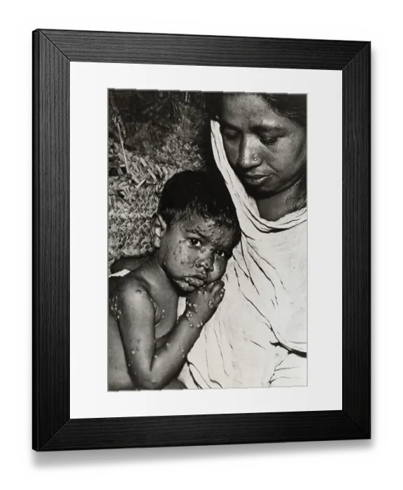 Framed Print : Woman Holding Boy with Smallpox Framed Print : Woman Holding Boy with Smallpox
