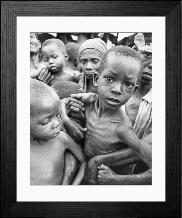 Framed Print : Malnourished Nigerian Child Framed Print : Malnourished Nigerian Child