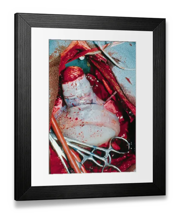 Framed Print : Mechanical Heart Being Transplanted Framed Print : Mechanical Heart Being Transplanted