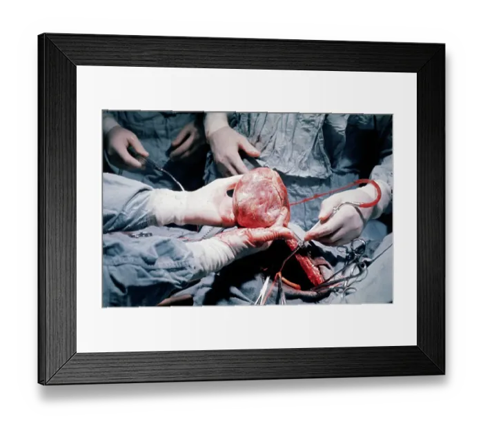 Framed Print : Heart Transplant Operation Framed Print : Heart Transplant Operation