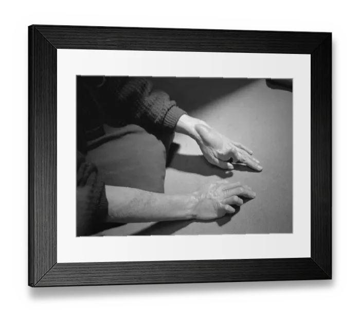 Framed Print : Deformed Hands Of Hiroshima Woman