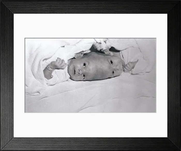 Framed Print : Conjoined Siamese Brodie Twins Framed Print : Conjoined Siamese Brodie Twins