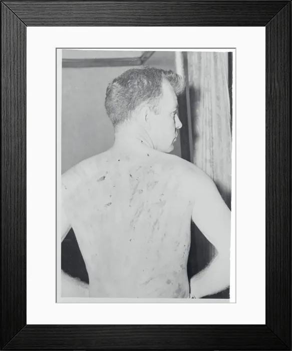 Framed Print : Scarred Back of Suspected Religious Sect Murderer Framed Print : Scarred Back of Suspected Religious Sect Murderer