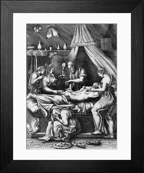 Framed Print : Illustration of Doctor Cupping Patient Framed Print : Illustration of Doctor Cupping Patient