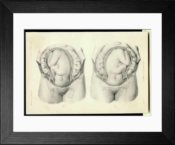 Framed Print : Diagrams of Baby Inside a Woman's Womb