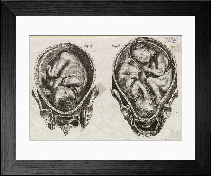 Framed Print : Illustration Depicting Fetuses in the Womb Framed Print : Illustration Depicting Fetuses in the Womb