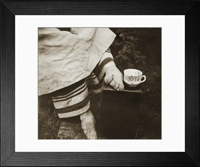 Framed Print : Chinese Woman's Feet Distorted by Foot Binding Practice Framed Print : Chinese Woman's Feet Distorted by Foot Binding Practice