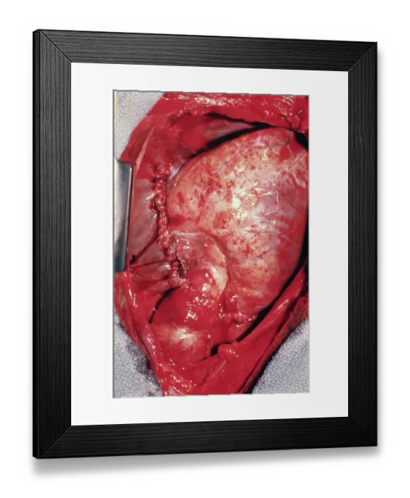 Framed Print : Donor's Heart in Thomas Chest Framed Print : Donor's Heart in Thomas Chest