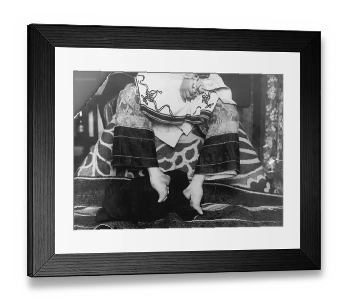 Framed Print : Chinese Woman Showing Emaciated Deformed Feet Framed Print : Chinese Woman Showing Emaciated Deformed Feet