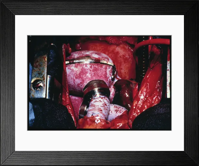 Framed Print : Installing Artificial Heart at Penn State University