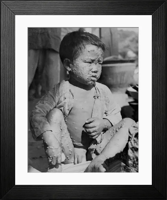 Framed Print : Child Suffering from Smallpox Framed Print : Child Suffering from Smallpox