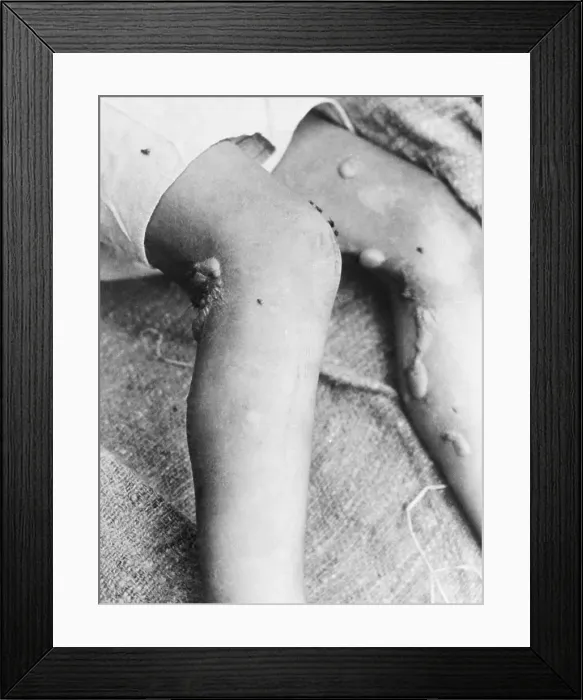 Framed Print : The Blistered Legs of a Chinese Soldier Framed Print : The Blistered Legs of a Chinese Soldier