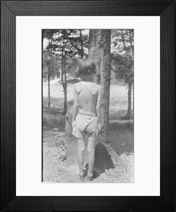 Framed Print : Back View of Child with Tuberculosis Framed Print : Back View of Child with Tuberculosis