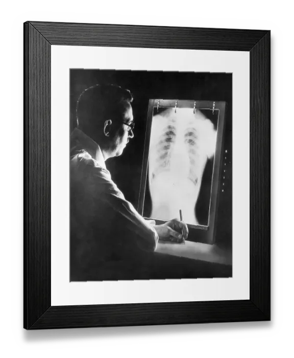 Framed Print : Tuberculosis X-Ray