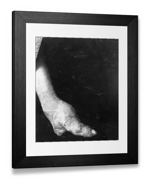 Framed Print : Example of Chinese Foot Binding Framed Print : Example of Chinese Foot Binding