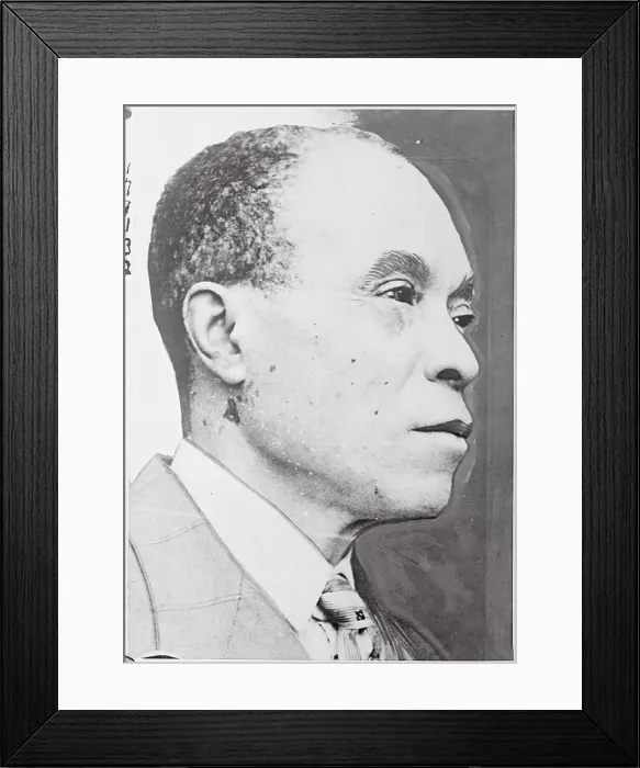 Framed Print : African American Suffering from Rare Skin Disease Framed Print : African American Suffering from Rare Skin Disease