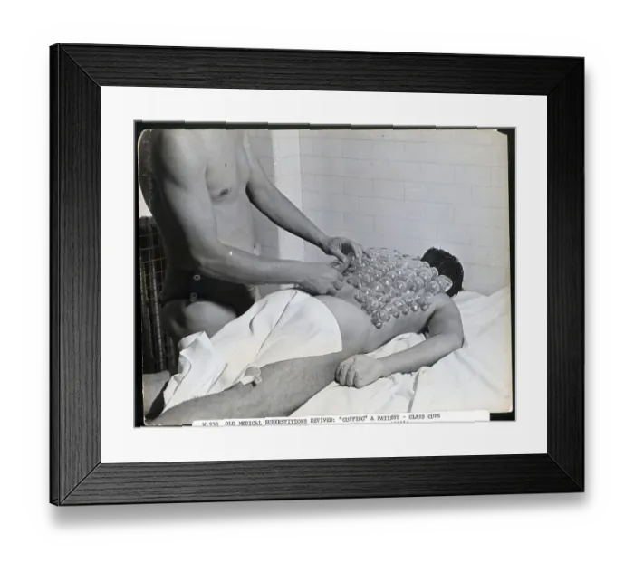 Framed Print : Cupping Patient During 1920S Revival Framed Print : Cupping Patient During 1920S Revival