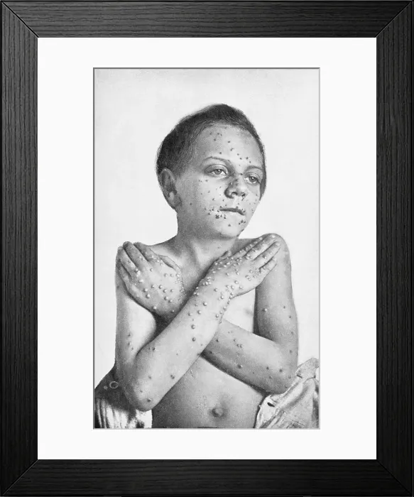 Framed Print : Child Stricken with Smallpox Framed Print : Child Stricken with Smallpox