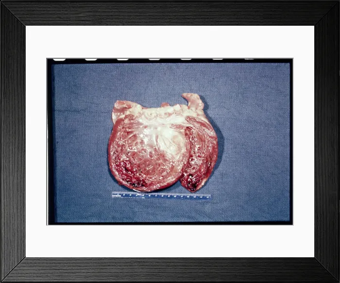 Framed Print : Photo of Cobbs diseased heart Framed Print : Photo of Cobbs diseased heart