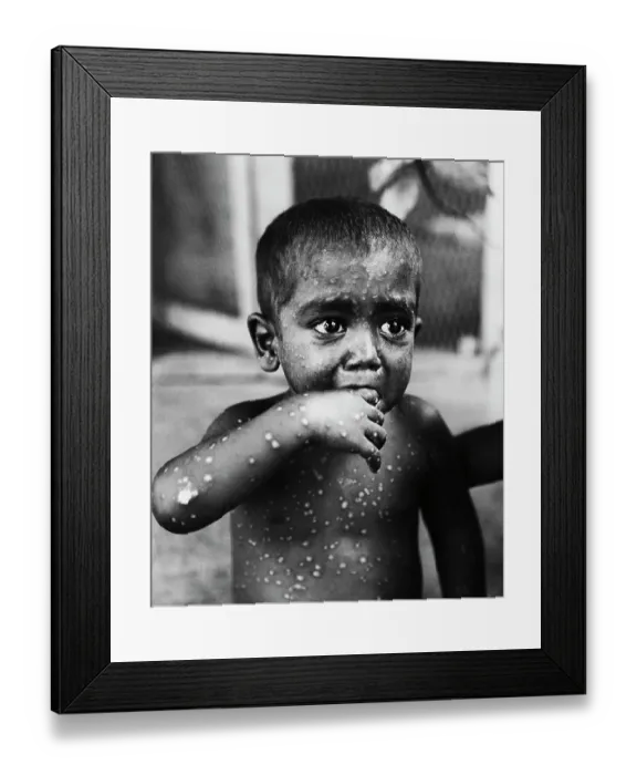 Framed Print : Small Boy Suffering from Smallpox Framed Print : Small Boy Suffering from Smallpox