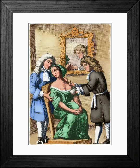 Framed Print : 17th Century Surgeon Performing Mastectomy Framed Print : 17th Century Surgeon Performing Mastectomy