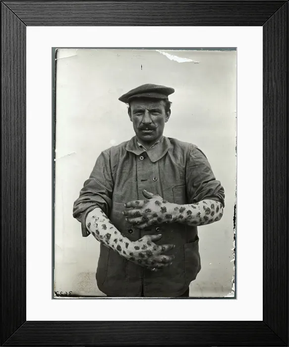 Framed Print : Man with Sores on Arms and Hands Framed Print : Man with Sores on Arms and Hands