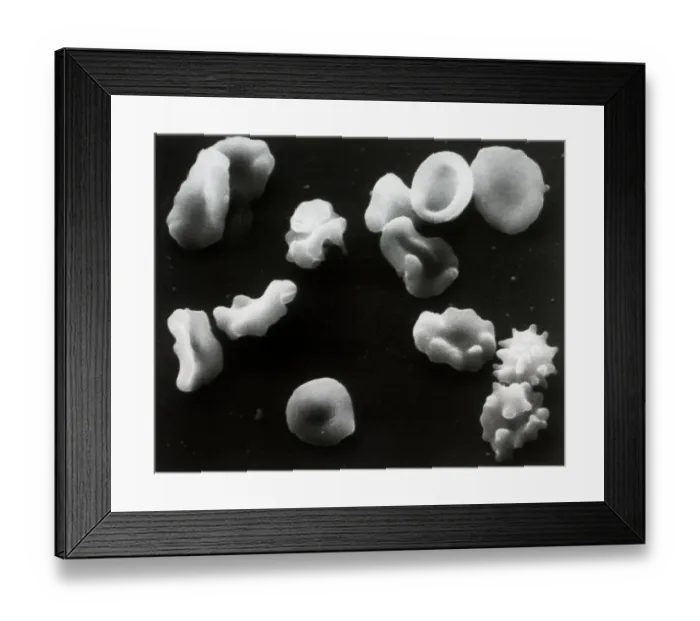 Framed Print : Cells Deformed by Sickle Cell Anemia Framed Print : Cells Deformed by Sickle Cell Anemia