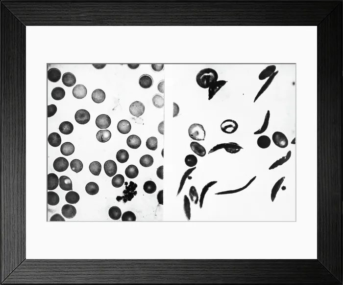 Framed Print : Blood Cells - Normal And Sickle Framed Print : Blood Cells - Normal And Sickle