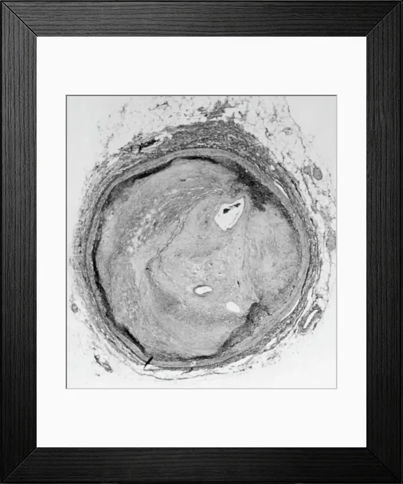 Framed Print : Arteries Choked By Plaque, Cholesterol Framed Print : Arteries Choked By Plaque, Cholesterol