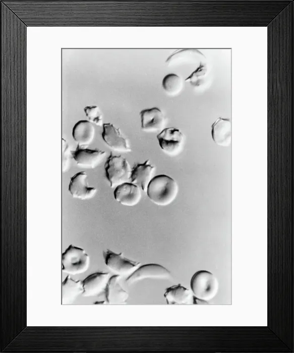 Framed Print : Microscopic Picture Of Sickle Cells Framed Print : Microscopic Picture Of Sickle Cells