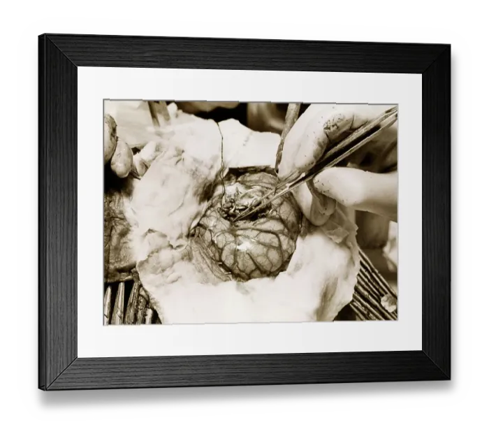 Framed Print : Closeup Of Brain Surgery; Brain Visible Framed Print : Closeup Of Brain Surgery; Brain Visible