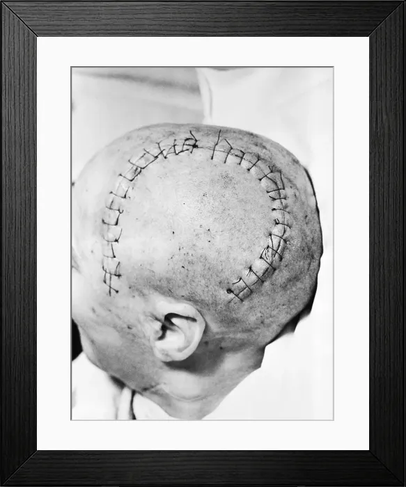 Framed Print : Sewn Wound On Shaven Skull From Surgery Framed Print : Sewn Wound On Shaven Skull From Surgery
