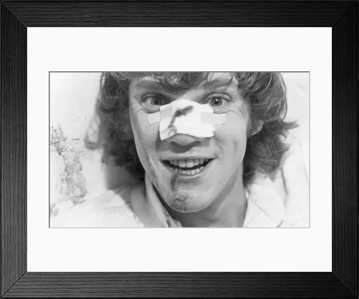 Framed Print : Closeup Of Malcolm Mcdowell W / Bloody Nos Framed Print : Closeup Of Malcolm Mcdowell W / Bloody Nos