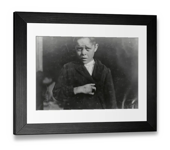 Framed Print : Child Laborer Who Lost Two Fingers in Accident