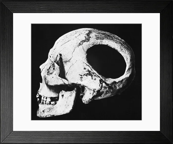 Framed Print : Neolithic Skull with Hole Framed Print : Neolithic Skull with Hole