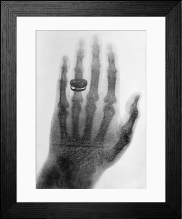 Framed Print : Early X-Ray of Hand Framed Print : Early X-Ray of Hand