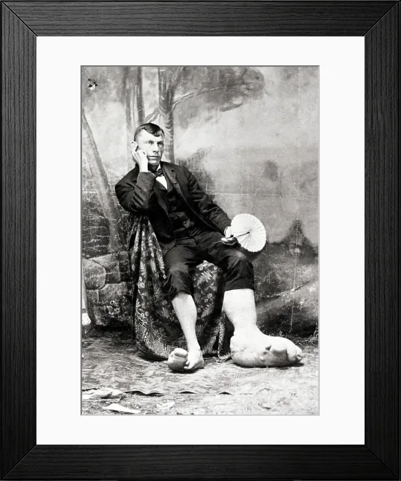 Framed Print : Man with Elephantaisis