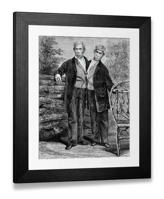 Framed Print : Siamese Twins Attached at Chest Framed Print : Siamese Twins Attached at Chest