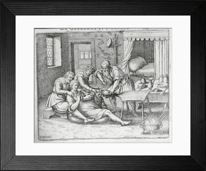 Framed Print : Drawing Showing Surgical Team During Amputation