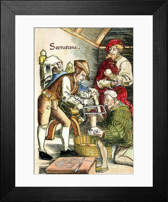 Framed Print : Drawing of an Early History Leg Amputation Framed Print : Drawing of an Early History Leg Amputation
